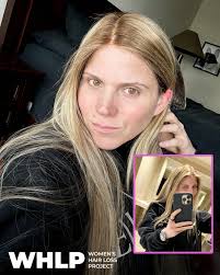 The Women's Hair Loss Project