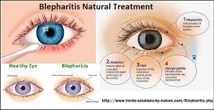 4 Home Base Natural Treatments For Blepharitis Blepharitis Natural Treatments Eyelash Mites Treatment