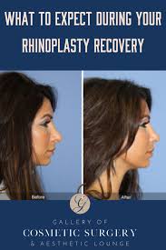 What To Expect During Your Rhinoplasty Recovery Your Recovery Can Depend On Your Specific Surgical Technique A Rhinoplasty Rhinoplasty Recovery Nose Surgery