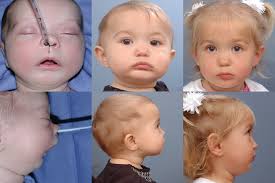 Pierre Robin Sequence Before & After Photos