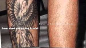 In 2008, pharrell revealed that he'd be trying a revolutionary new tattoo removal procedure that involves applying new skin over old body art. Best Natural Tattoo Removal Without Costly Laser Treatments Or Creams Youtube