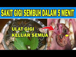 Ulat Di Gigi Keluar Semua Cara Menyembuuhkan Sakit Gigi Dengan Cepat Dunia Herbal Youtube Di 2020 Obat Alami Kesehatan Resep Sehat