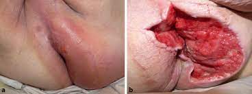 Fournier's gangrene severity index as a predictor of outcome in patients with fournier's gangrene: Fournier Gangran Als Sonderform Der Nekrotisierenden Fasziitis Springerlink