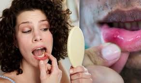 Very often mouth cancer does not produce symptoms in the early stage. Mouth Cancer Symptoms Signs Of A Tumour Include An Ulcer And Difficulty Swallowing Express Co Uk