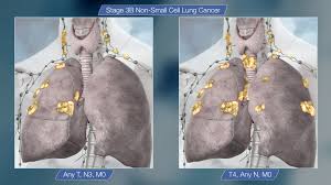 During this time, they discovered that applying the moldy curd of soybeans to infections had you should avoid using any antibiotic to which you have previously had an allergic reaction. Stage 3 Lung Cancer All That You Need To Know Scientific Animations