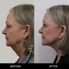 At 70 years young, this stunning patient wanted to look as vibrant