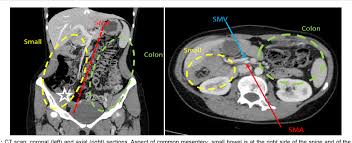 Image result for Intestinal Malrotation