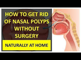 Homeopathy remedies have effective cures to reduce nasal polyp and lessen the symptoms over time. How To Get Rid Of Nasal Polyps Without Surgery Naturally At Home Polyp How To Get Rid Sinus Remedies