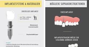 Wenn man umziehen möchte, dann herrscht das chaos. Wie Lauft Eine Zahnimplantation Ab Schritt Fur Schritt Erklart Gelencser Dental Magazin