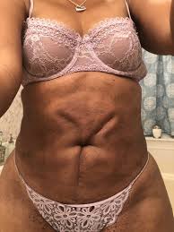 One the major advantages is that by liquefying the fat cells, it is. What Can I Do To Smooth Or Remove Dents From My Abdomen That Appeared After Smart Lipo Photo