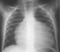 What Is An Enlarged Heart Pediatric Heart Specialists