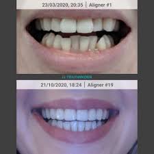 On average, clear aligners will range in cost from $1,800 to $10,000 across the united states. And She S Done Invisalign Lite With Refinements 7 Months Invisalign
