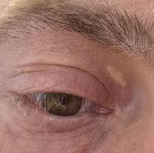 Image result for xanthelasma of eyelid
