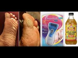 Mix equal parts listerine, vinegar and water. Apple Cider Vinegar Dry Itchy Callus Feet Dr Scholls Pedi Express Youtube