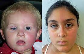 Congenital Cases Of Concomitant Harlequin And Horner Syndromes The Journal Of Pediatrics