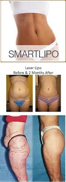 Liposuction Palm Beach Gardens Smart Lipo Liposuction Laser Lipo