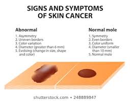 Skin Cancer Images Stock Photos Vectors Shutterstock