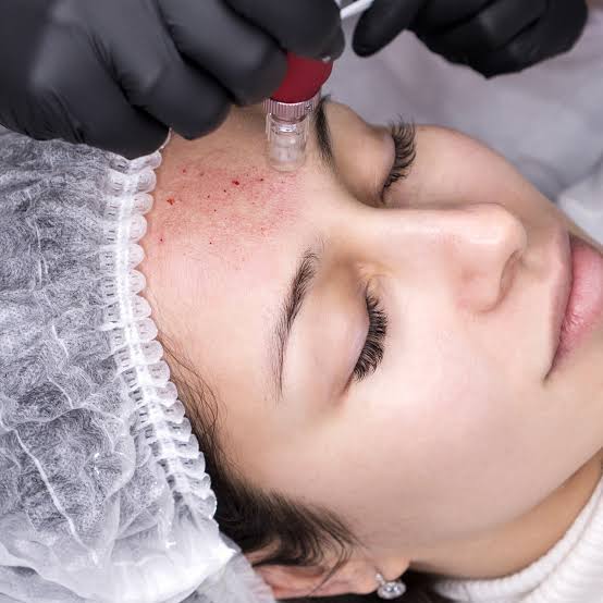 Medical Microneedling Treatment