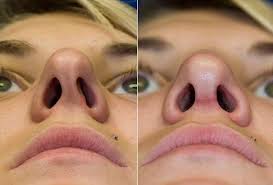 Everything You Need To Know About Functional Rhinoplasty Septoplasty Via Thomas Lamperti Md Nosejob Nasal Septum Rhinoplasty Surgery