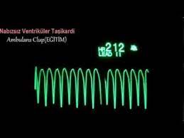 Geniş kompleks taşikardi (qrs ≥ 0,12 saniye) sinüs taşikardi > 150 bpm supraventriküler taşikardi svt ve anormallik düzensiz taşikardi atriyal fibrilasyon (kalın ve ince), atriyal flutter, unstabil monomorfik ventriküler taşikardi (120 bpm ila 300 bpm), torsade de pointes/polimorfik ventriküler taşikardi (uzun qt aralığı) Ambulans Clup Nabizsiz Ventrikuler Tasikardi Youtube