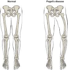 Long bones are generally bones that are longer than they are wide, and are part of the skeletal axis ; Bone Structure Anatomy And Physiology