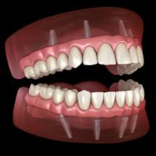 Supreme Dental Clinic: Dentist Los Algodones MX