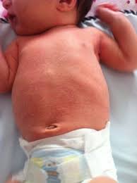 Quick way heal baby's dry spots and prevent them.products:unscented. Dry Skin April 2015 Babycenter Canada