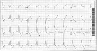 Heart murmurs and other abnormal heart sounds like galloping, clicks, or rubs can be caused by a number of heart conditions. An Extraordinary Case The American Journal Of Medicine