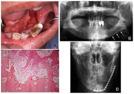 A sore throat or persistent feeling that something is caught in the throat. The Rankl Rank System As A Therapeutic Target For Bone Invasion By Oral Squamous Cell Carcinoma Review
