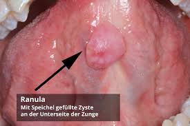 Und manchmal kann die mundschleimhautentzündung, medizinisch stomatitis, so ausgeprägt sein, dass. Froschleingeschwulst Ranula Ursachen Therapie Prognose