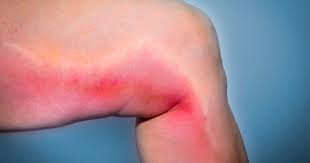 Center For Vein Restoration La Flebitis Podria Estar Causando El Bulto Duro En Su Vena Varicosa