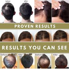 Hair loss in women is just that — when a woman experiences unexpected, heavy loss of hair. Buy Hair Growth Oil Scalp Serum Large 1 7oz 100 Natural Hair Growing Scalp Treatment To Promote Stronger Thicker Longer Hair Regrowth For Men And Woman Hair Loss Products For Hair