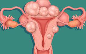 Do ovarian cancer symptoms come on suddenly? Women Are Now Posting Photos Of Their Uterine Fibroids All Over Reddit Women S Health