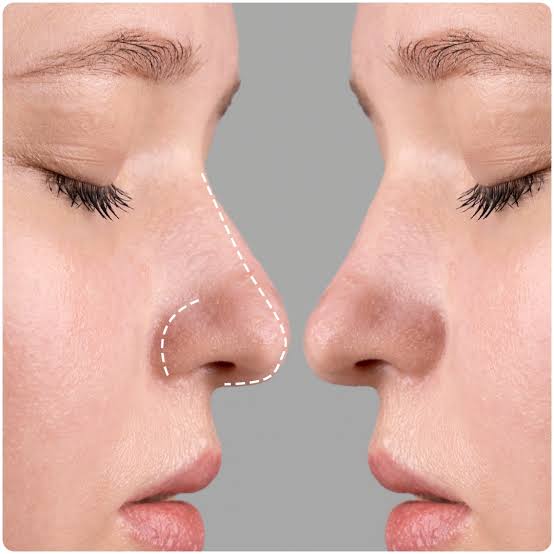 Rhinoplasty in Ahmedabad | Nose Reshaping & Breathing Care