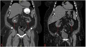 Image result for Nephrolithiasis Imaging