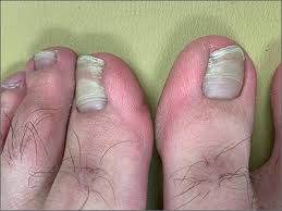 Image result for Beau lines feet