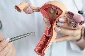 Image result for Vulvar Cancer