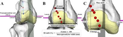 Image result for Patella Tracking Assessment