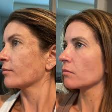 Mandi Lonergan FNP-C (@mandi_forthefacebayarea) · Palo Alto, CA