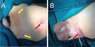 If you noticed a sudden pain in the groin or a sensation as if something had torn a hernia is a weakness or tear in the abdominal muscle wall, which normally holds the inner lining of the. A Comparative Study Examining Laparoscopic And Open Inguinal Hernia Repair In Children A Retrospective Study From A Single Center In China Bmc Surgery Full Text
