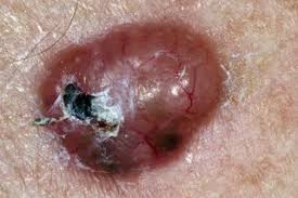 This is the most common type of skin cancer. Non Melanoma Skin Cancer Nhs