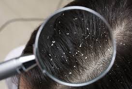 Image result for lice vs dandruff