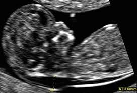 The person performing the nt scan may also ask you to drink a glass of water before you begin. Fetal Biometry In Early Pregnancy First Trimester Ultrasound A Comprehensive Guide