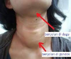 Check spelling or type a new query. Benjolan Mana Yang Harus Dioperasi Dulu Dok Kompasiana Com