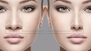 Eksperyans mwen ak rinoplasti ak konplikasyon li yo