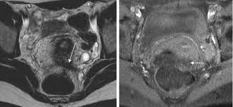 However, mri imaging signs are also extremely polymorphic with a wide possibility of sites 9. Mri Atlas Of Ectopic Endometriosis Sciencedirect