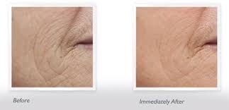 Kate somerville dermalquench liquid lift advanced wrinkle treatment 4.2 out of 5 stars 48 ratings | 4 answered questions price: Review And Giveaway Kate Somerville Dermalquench Liquid Lift Advanced Wrinkle Treatment Hello Beauty