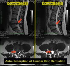 Mri Lss Auto Resorption Of Lumbar Disc Herniation Disk Herniation Lumbar Disc Lumbar