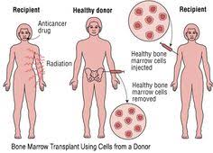 This is because multiple myeloma forms in the bone marrow and, as time goes on, the suppression of healthy red blood cells can cause the bone to thin and weaken, resulting in osteoporosis. Bone Marrow