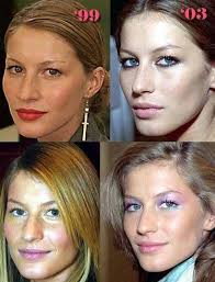 Celebrity Nose Jobs Before And After Hair Implants Celebrity Plastic Surgery Cool Hair Color
